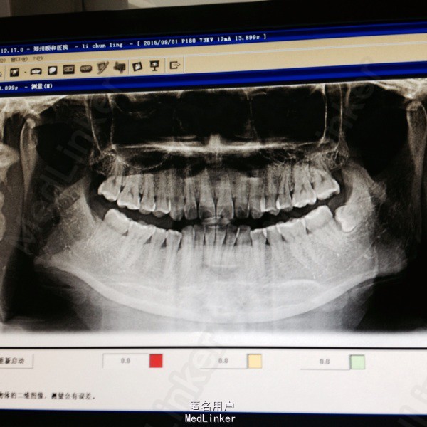 左髁状突肥大1例