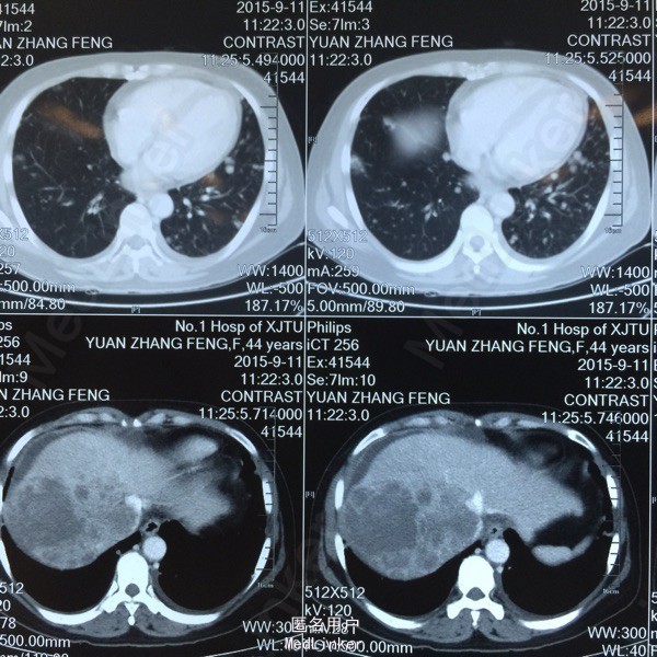 巨块型肝癌合并肺转移 肺结核1例 医联