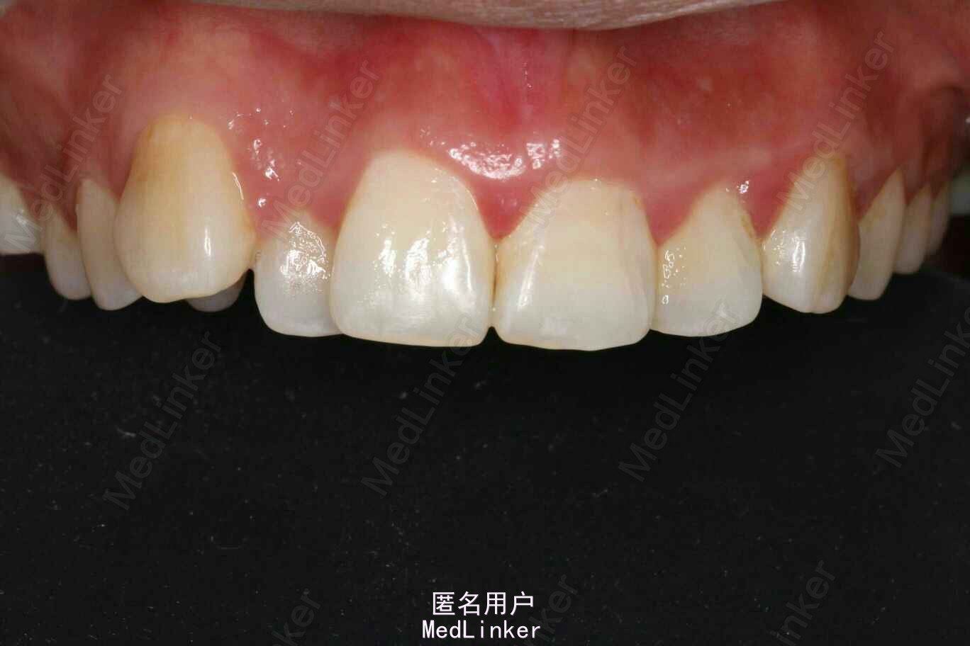 图3-52 下颌尖牙-基础医学-医学