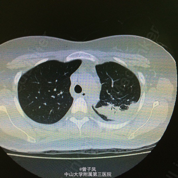 结核性胸膜炎、肺结核