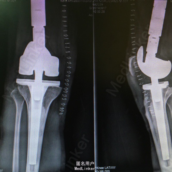 诊断 处理 行右膝关节置换术.术后病理诊断为硬化性骨肉瘤