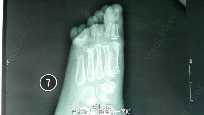 小儿,女,4岁,左足小趾多趾并趾畸形.屈伸活动可.
