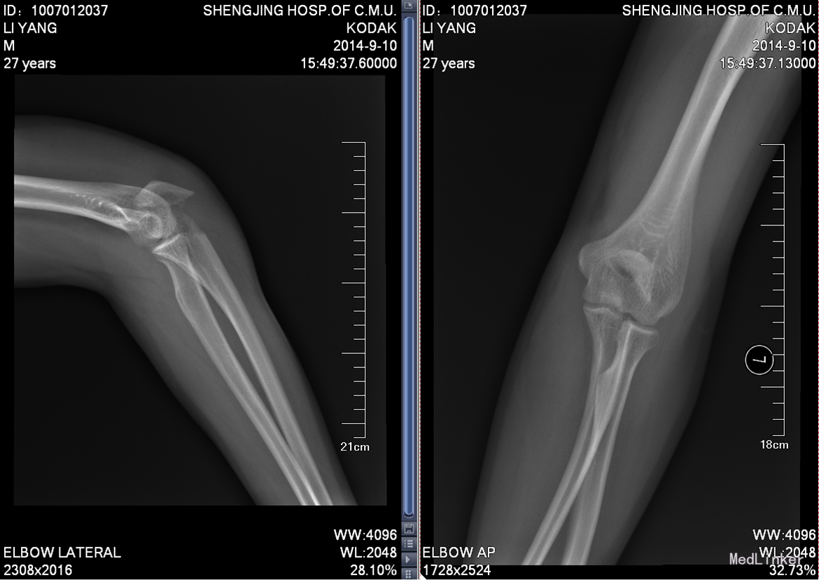 左手尺骨鹰嘴骨折一个月后才去做手术的经过 - 知乎