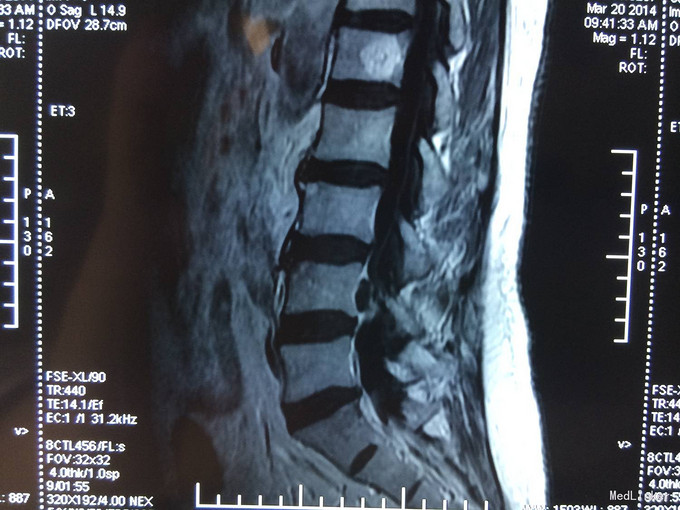 腰椎间盘脱出症髓核游离