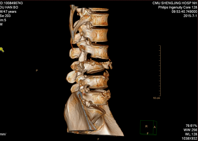 腰3,4,5椎体骨折,腰3椎体滑脱,腰3横突骨折,脊髓损伤,双下肢不全瘫