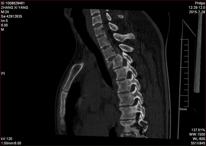 胸椎骨折腰椎横突骨折胸2椎滑脱