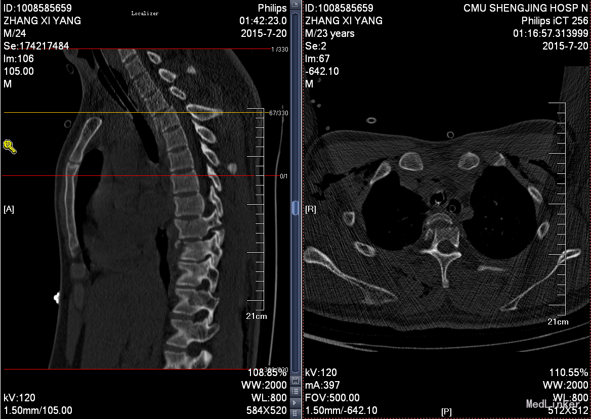 CT、X光、核磁共振，谁更适合腰突症检查，你都了解吗？