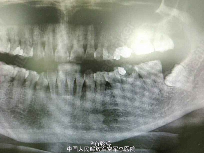 慢性根尖周炎急性发作