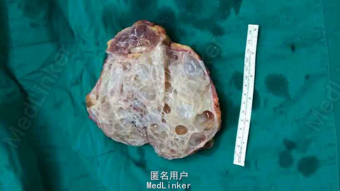 诊断 处理 诊断:右肾囊性肿物性质待查,双肾囊肿 治疗:给予经腹腔镜