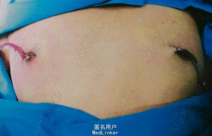 手术还是吸脂?
