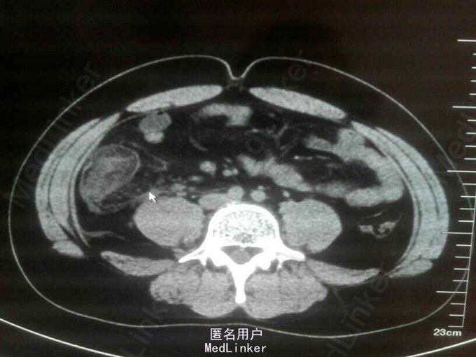 急性坏疽性阑尾炎