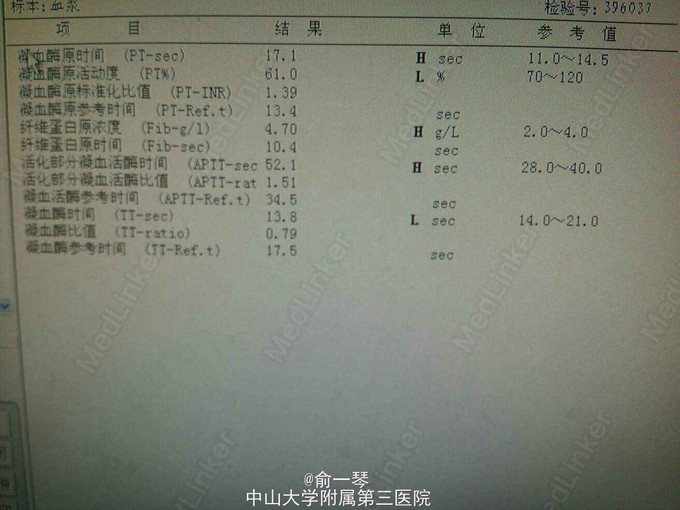 别嘌醇过敏全身剥脱性皮炎mods