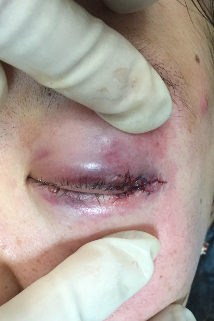 诊断 处理 诊断:左眼睑挫裂伤  治疗:眼睑部创口行清创缝合,眶内侧壁