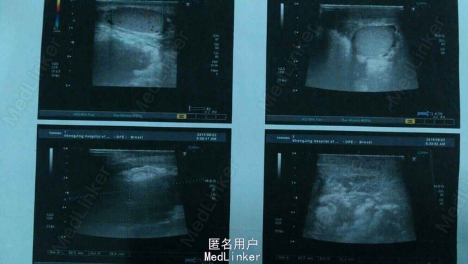 而后出现阴囊胀痛,阴囊青紫,排尿正常,来我院急诊查阴囊彩超诊断为