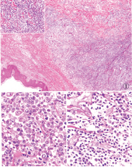 原发皮肤外周t细胞淋巴瘤1例