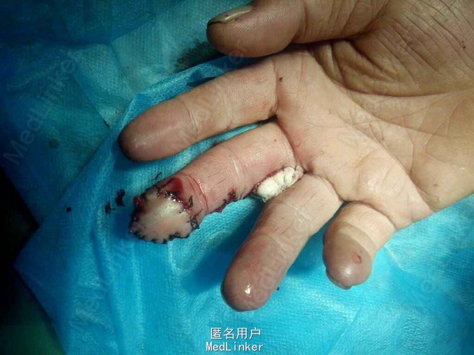 右中指末节皮肤缺损,指动脉岛状皮瓣修复.