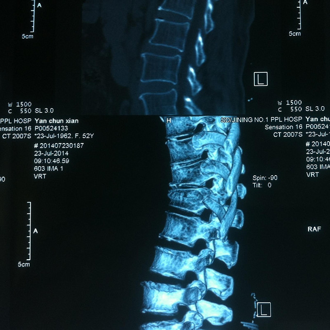 腰椎骨折保守治疗效果较好 病例分享