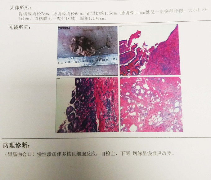 胃大部分切除术后半年上消化道出血