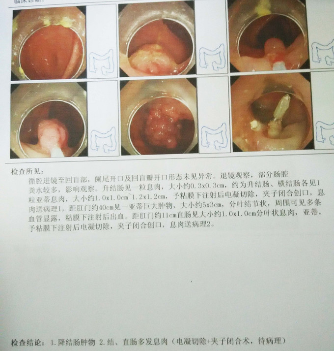 烂便发现乙状结肠肿物1例