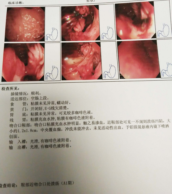 胃大部分切除术后半年上消化道出血