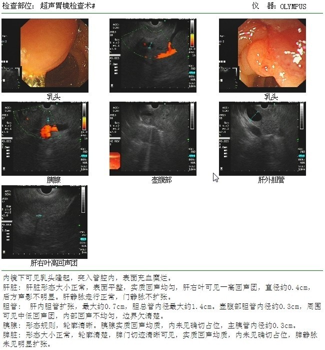 肝胰壶腹周围占位