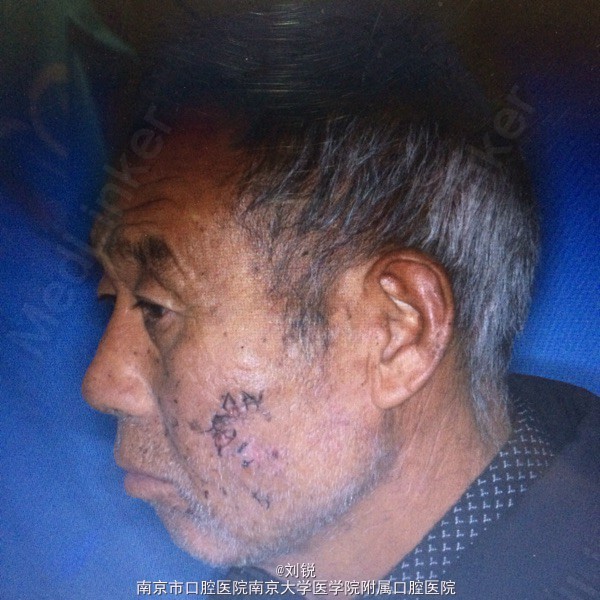 面部瘘管1周