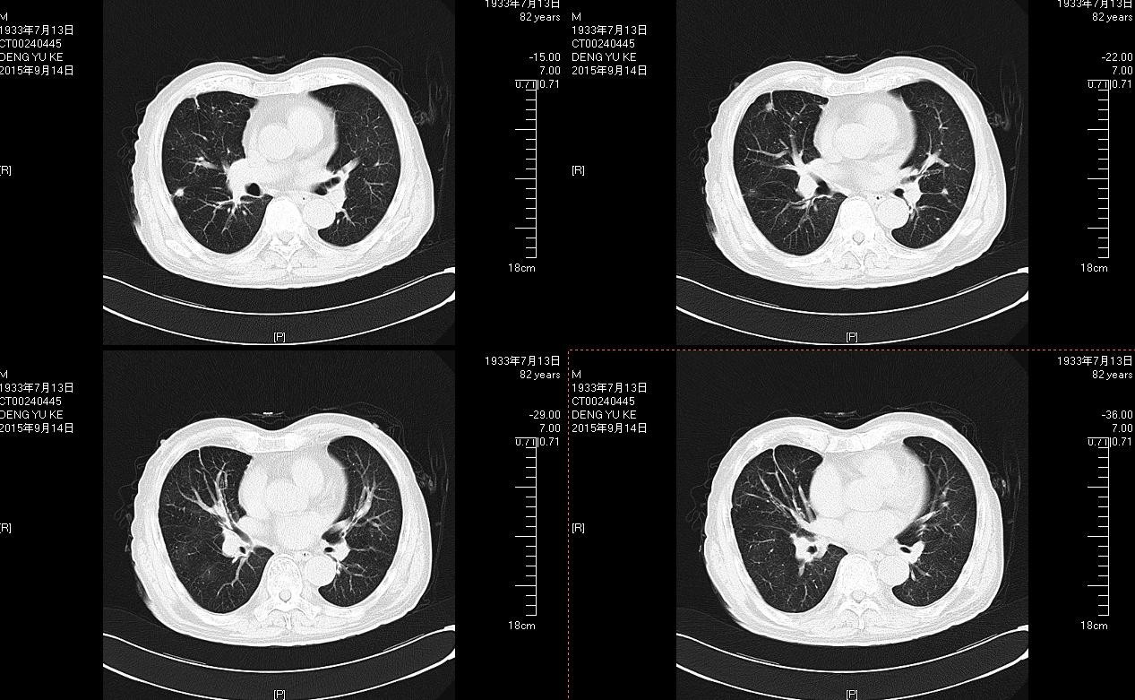 右下肺结节病例2016.4.14【91360呼吸沙龙案例31】 - 呼吸系统 - 91360病理论坛