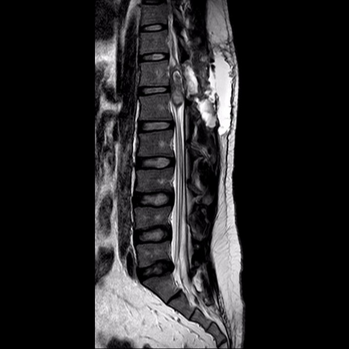 t12-l1水平椎管内脂肪瘤