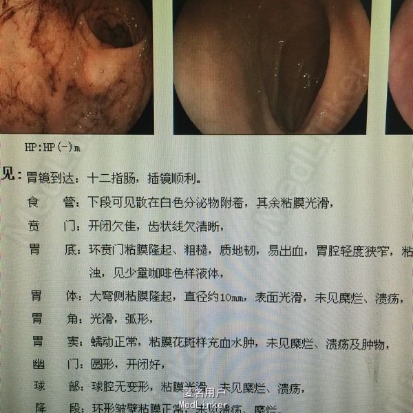 查体 辅查 上腹部压痛.全腹ct提示胃癌,腹腔转移.