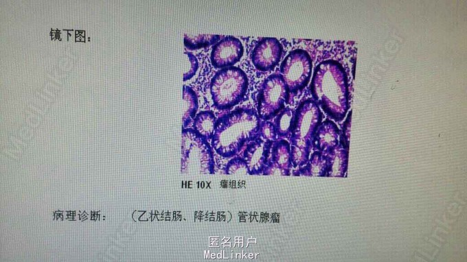 行肠镜示结肠多发息肉,行内镜下圈套电切,术后病理提示管状腺瘤