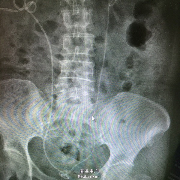 六年前因放疗术后输尿管下段狭窄,右侧行再植术,左侧行双j管植入术后