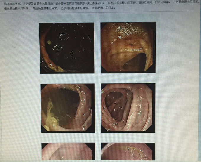 卵巢黄体破裂误诊卵巢肿瘤1例