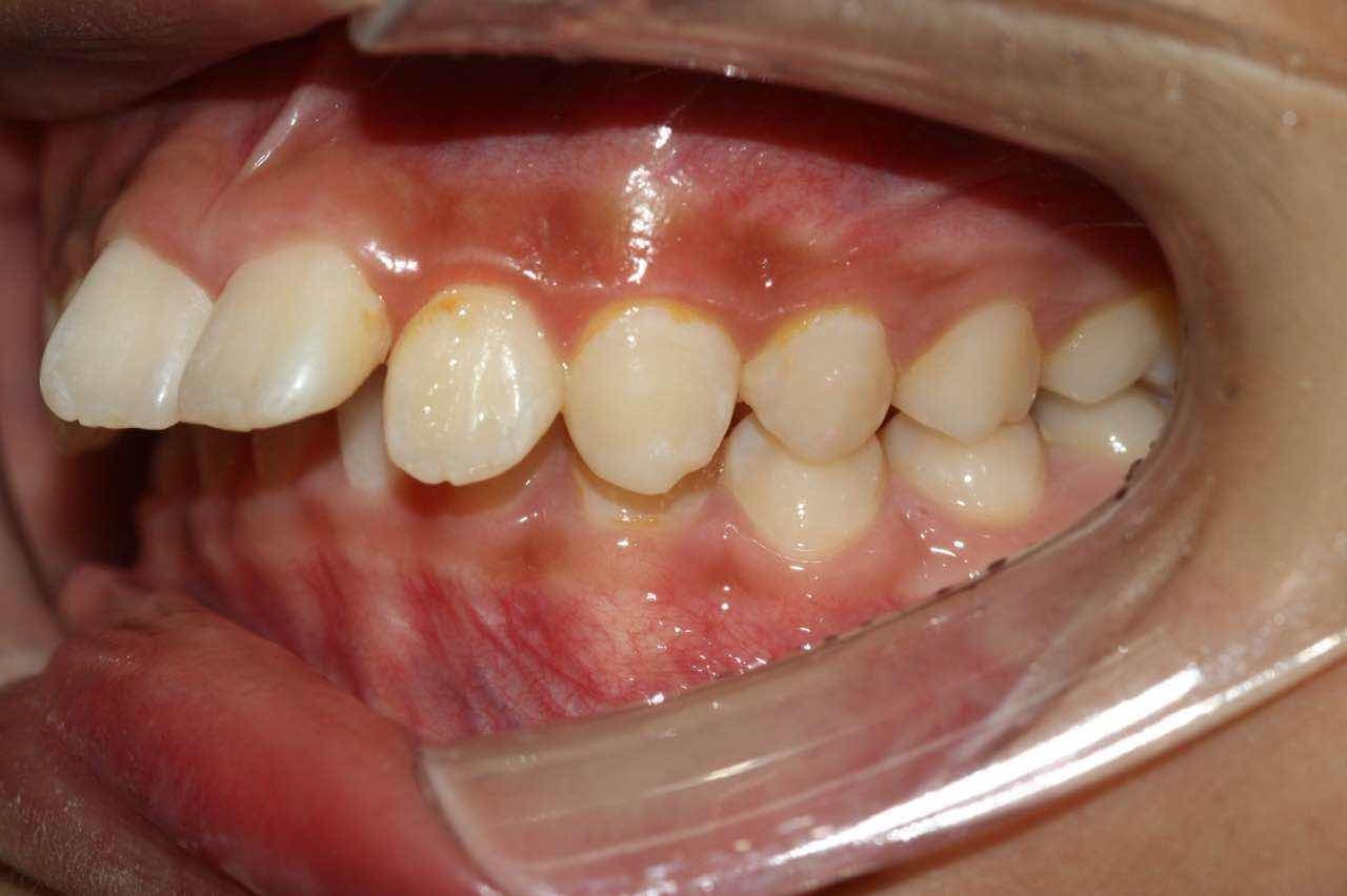 石家庄牙齿矫正郑希医生案例集：门牙对刃、深覆盖、深覆颌深覆盖的正畸案例解析 - 哔哩哔哩