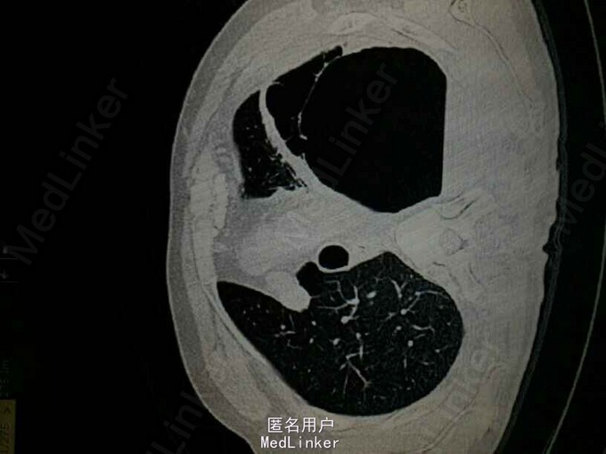 复杂肺大泡一例分析