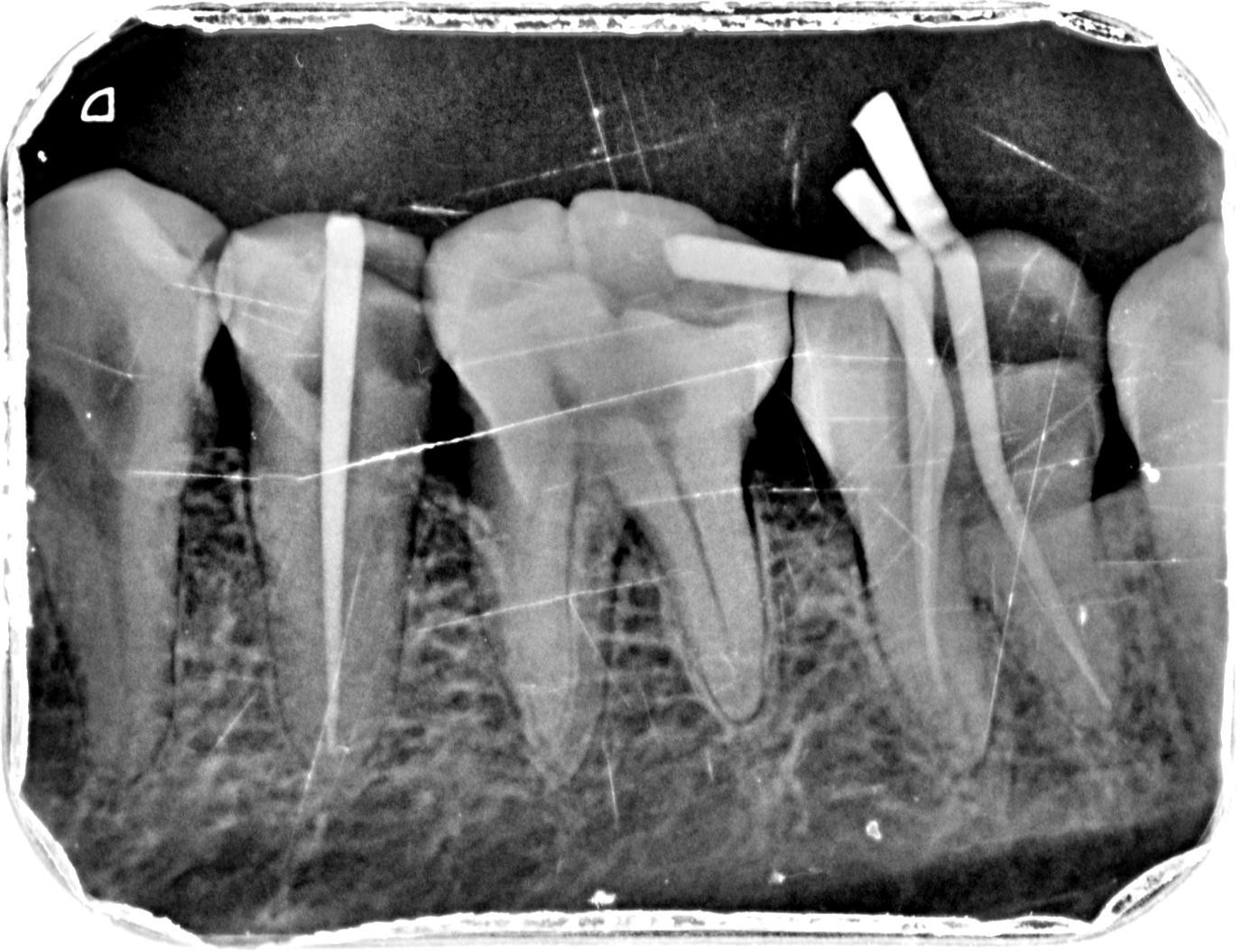 战“疫”|爱牙护齿㊵ 拔牙后的牙洞，是怎么填满的？_澎湃号·政务_澎湃新闻-The Paper