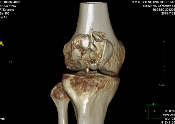右髌骨开放性骨折