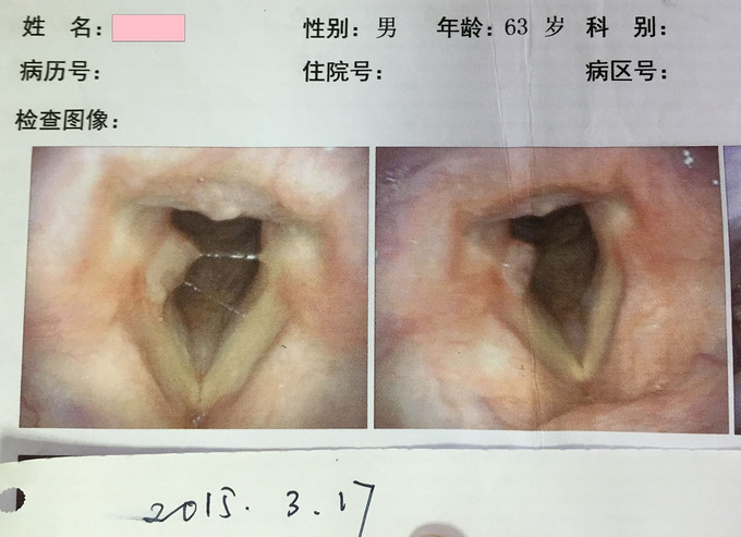 肉芽 腫 喉頭