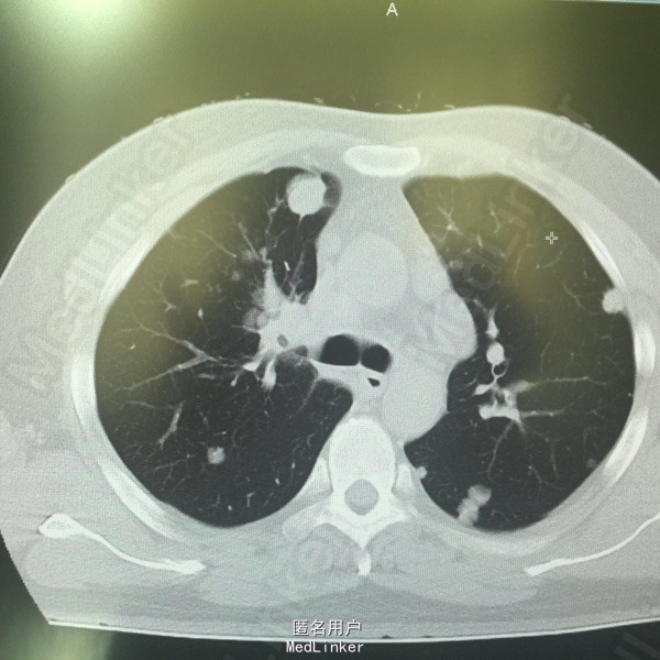 10月患者因咳嗽咳痰,伴有右锁骨上淋巴结肿大,肺ct检查提示双肺占位性