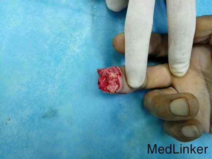右中指末节指腹皮肤缺损近节指背皮瓣修复.