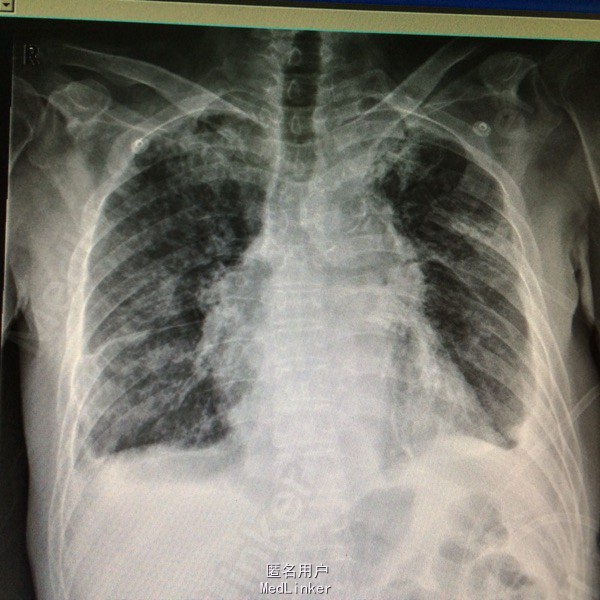 肺癌 末期