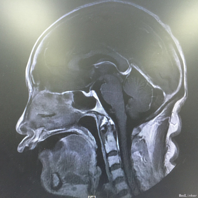 怀疑鼻腔恶性肿瘤的真菌性鼻窦炎1例