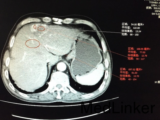 肝癌:增强ct,典型"快进快出".