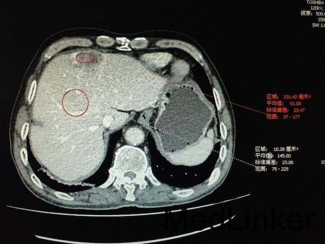 肝癌:增强ct,典型"快进快出".