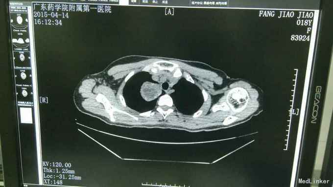 右第一肋骨软骨母细胞瘤继发动脉瘤样骨囊肿一例