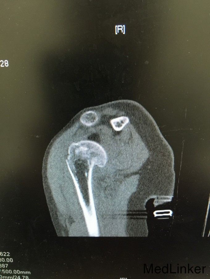 右肱骨近端粉碎性骨折