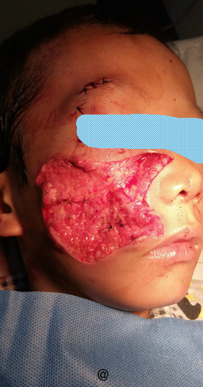 狗咬伤致颜面部皮肤缺损,行扩创植皮术一例