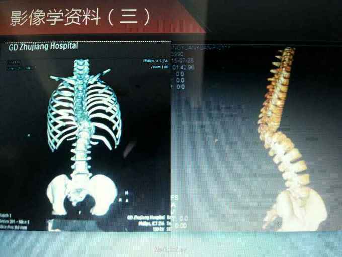 先天性胸10,胸11半椎体伴严重僵硬性脊柱侧后凸畸形