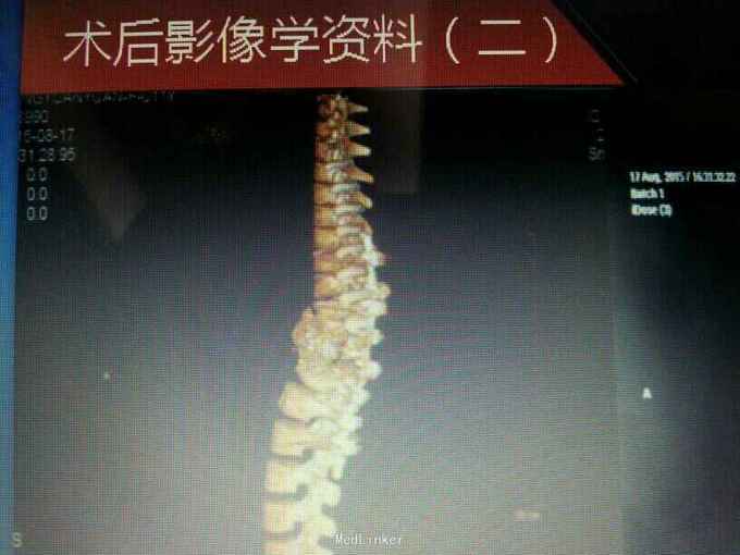 先天性胸10,胸11半椎体伴严重僵硬性脊柱侧后凸畸形