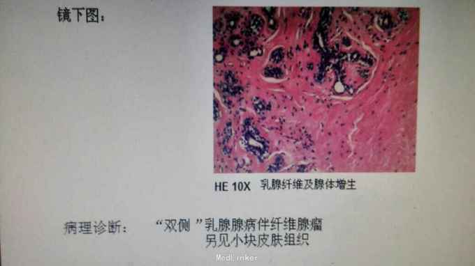 术后病理提示左侧纤维瘤,右侧为乳腺腺病.
