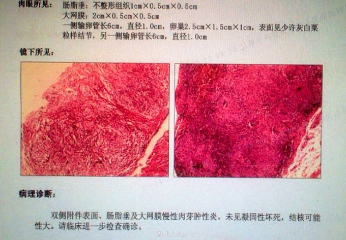 盆腹腔结核,结核性腹膜炎